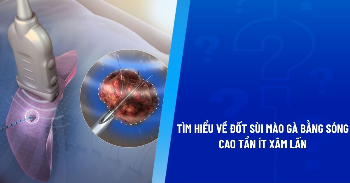 đốt sùi mào gà bằng sóng cao tần