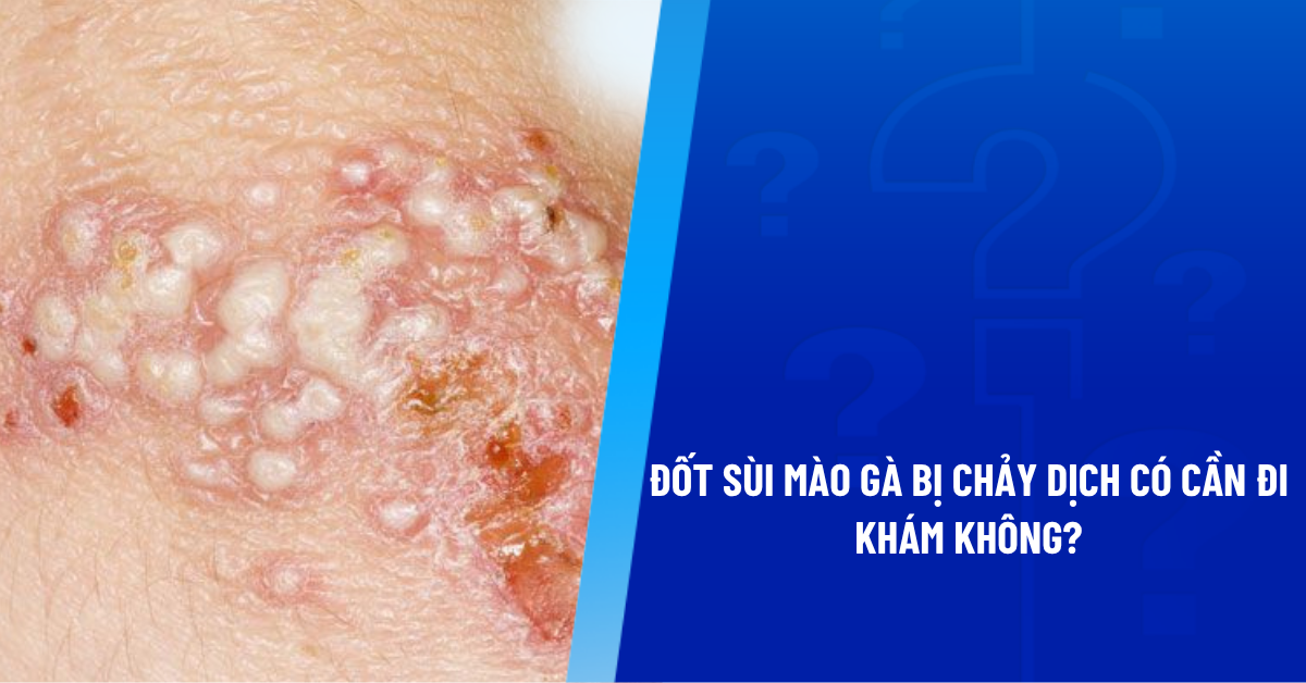 đốt sùi mào gà bị chảy dịch