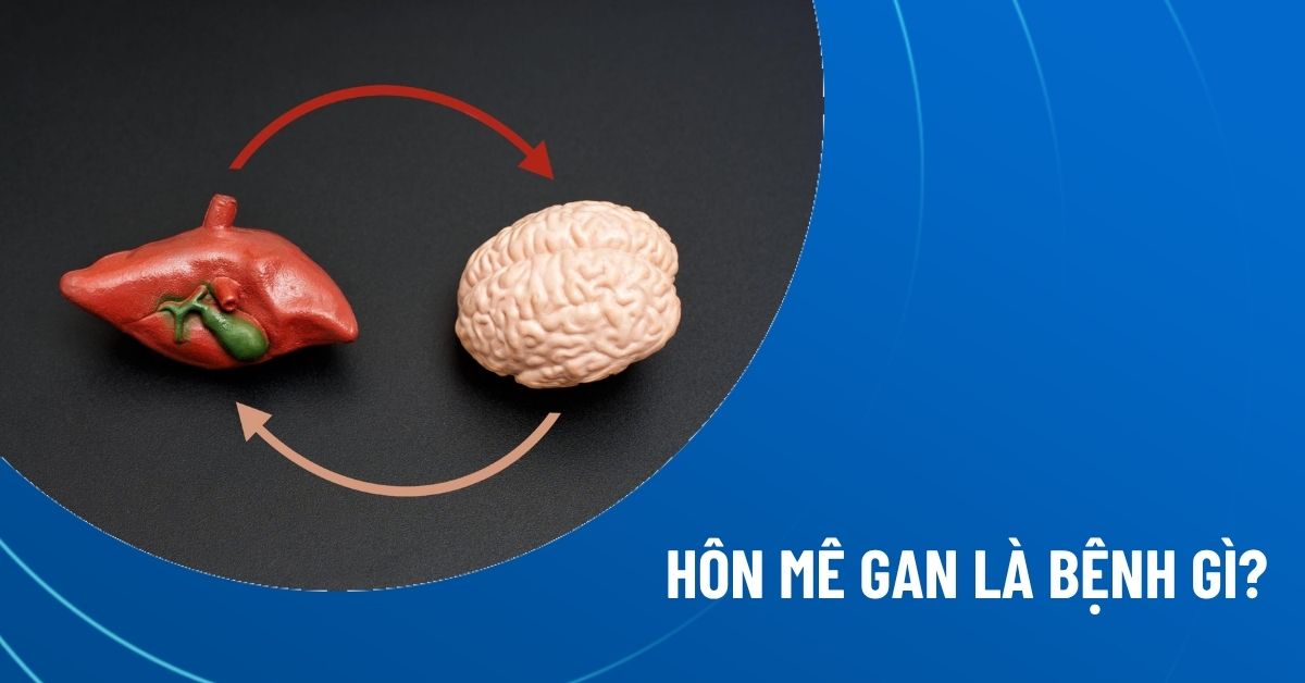 hôn mê gan