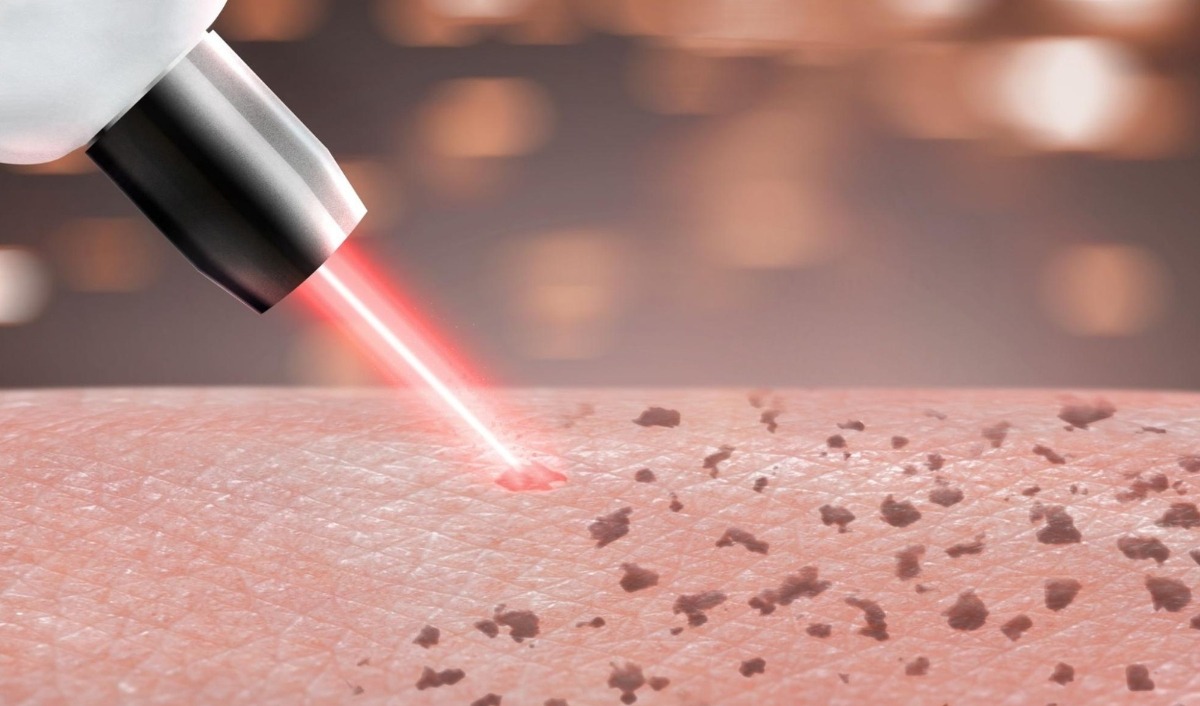 bắn tia laser trị sắc tố da