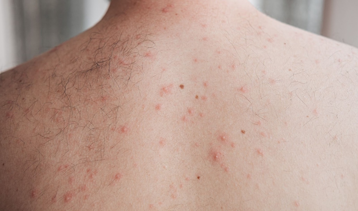 lưng mọc mụn thủy đậu nhẹ