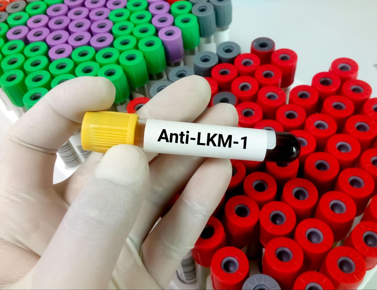 mẫu xét nghiệm anti lkm1