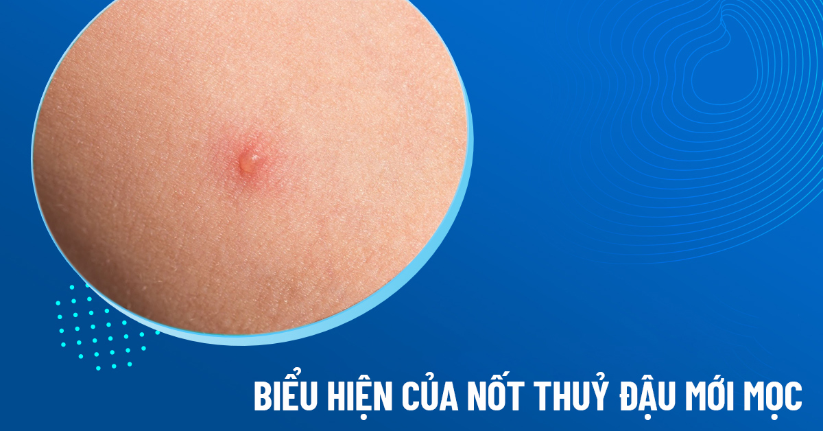 nốt thủy đậu mới mọc