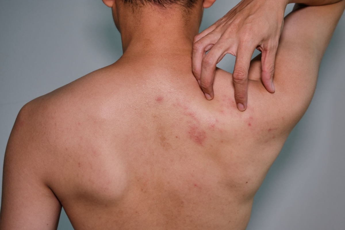 nốt thủy đậu trên lưng