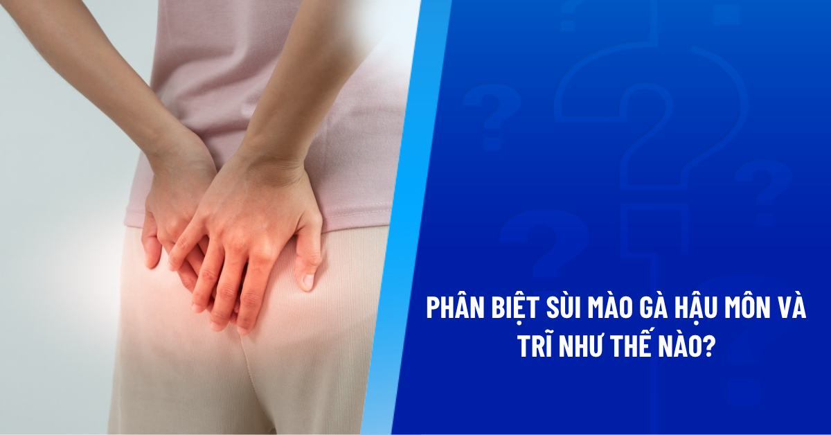 sùi mào gà hậu môn và trĩ