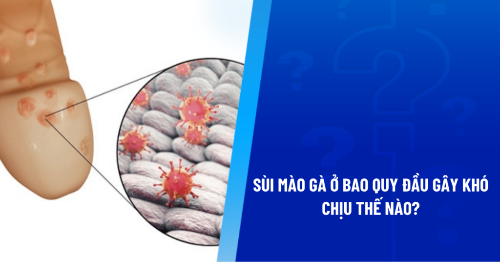 sùi mào gà ở bao quy đầu