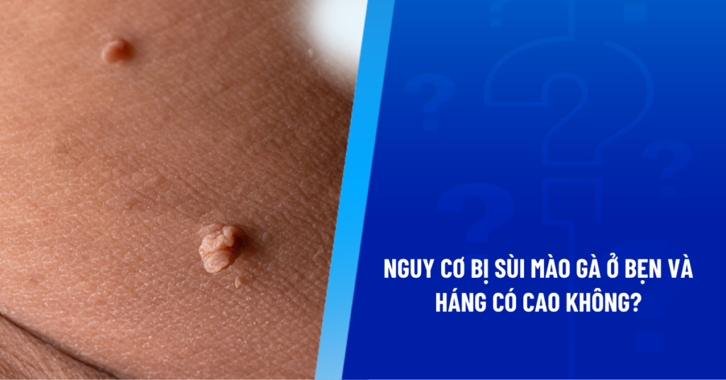 sùi mào gà ở bẹn