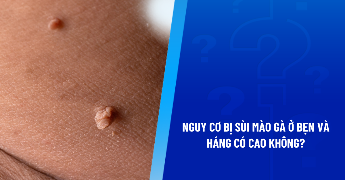 sùi mào gà ở bẹn