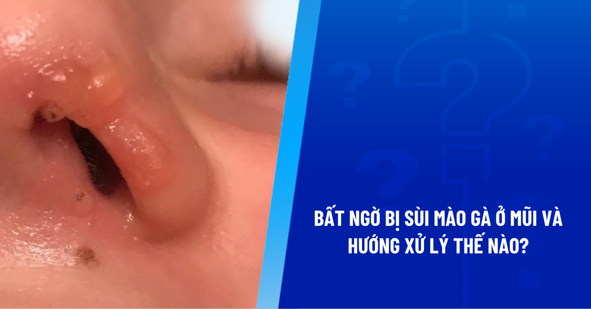 sùi mào gà ở mũi