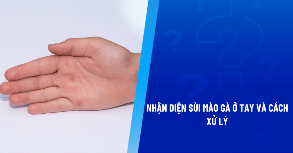 sùi mào gà ở tay