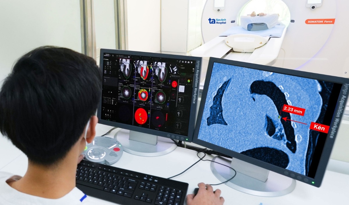 chụp ct tầm soát não ở tâm anh