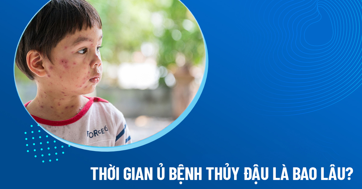 thời gian ủ bệnh thủy đậu