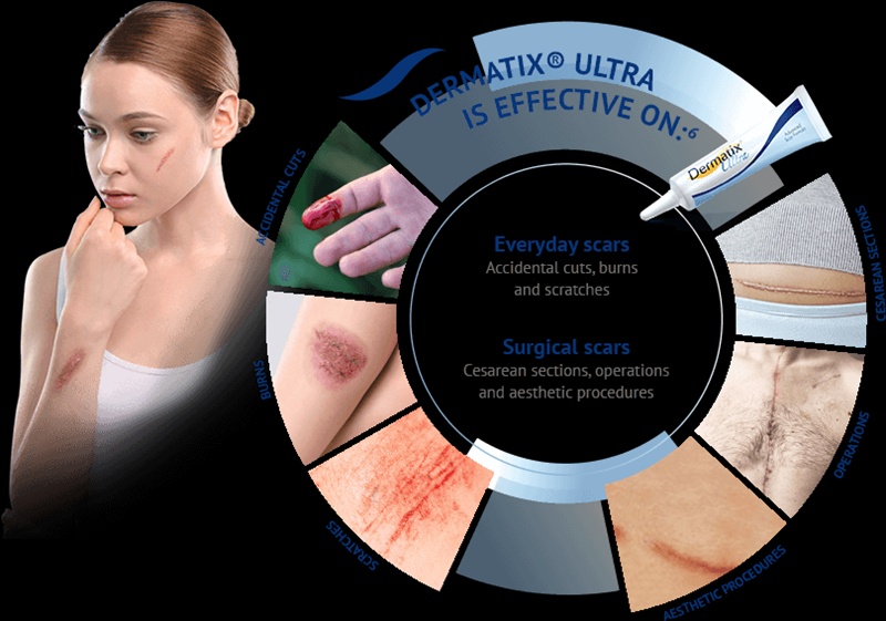 thuốc trị sẹo dermatix