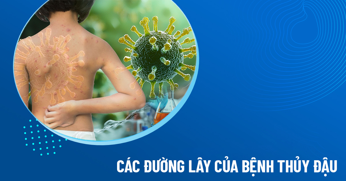 thủy đậu có lây không