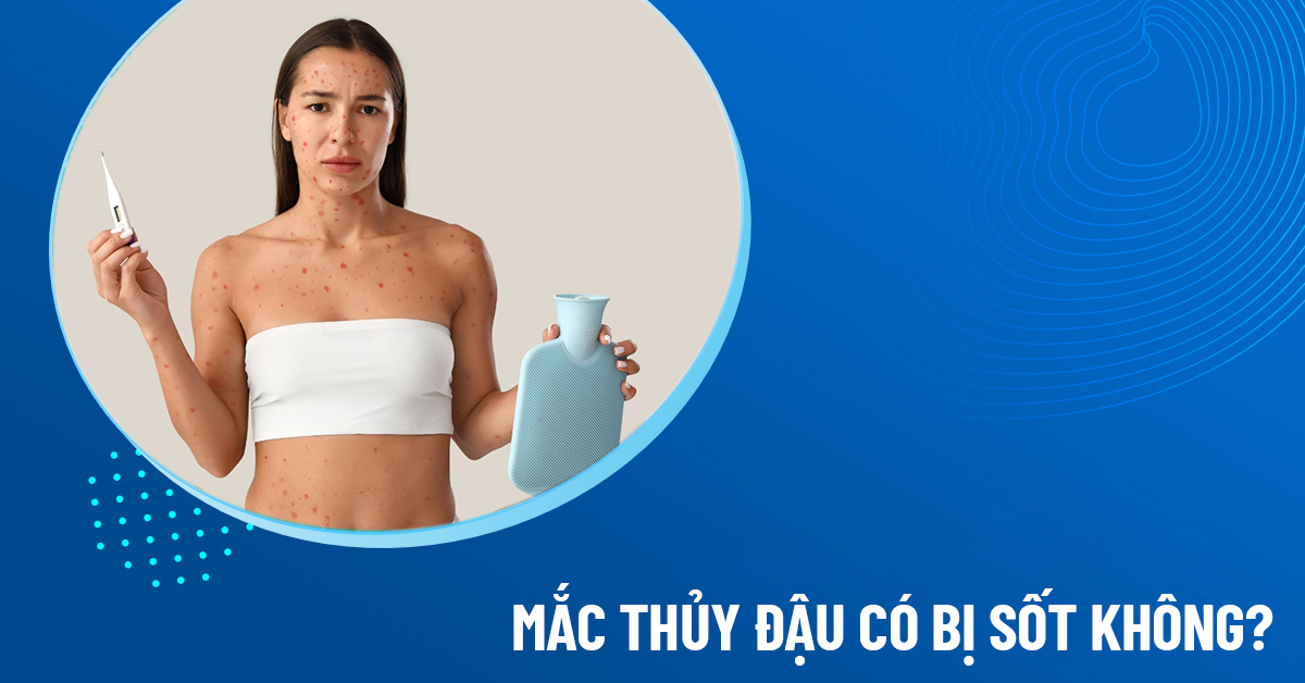 thủy đậu có sốt không