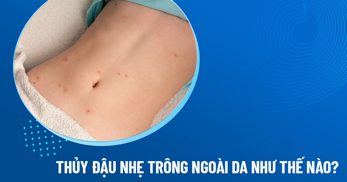thủy đậu nhẹ