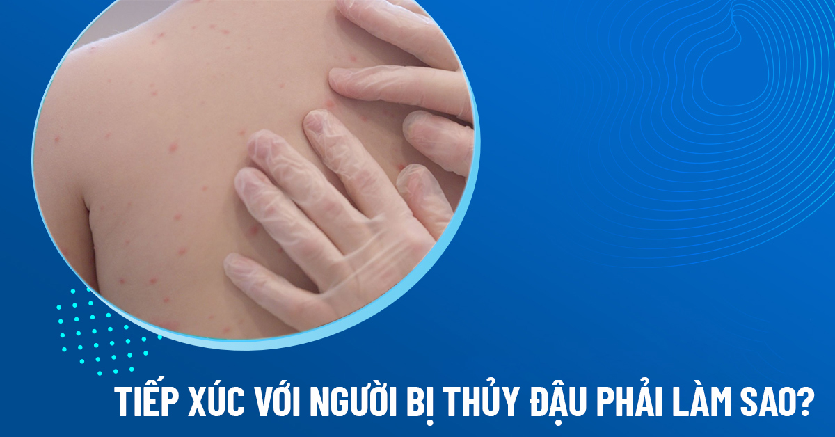 tiếp xúc với người bị thủy đậu phải làm sao