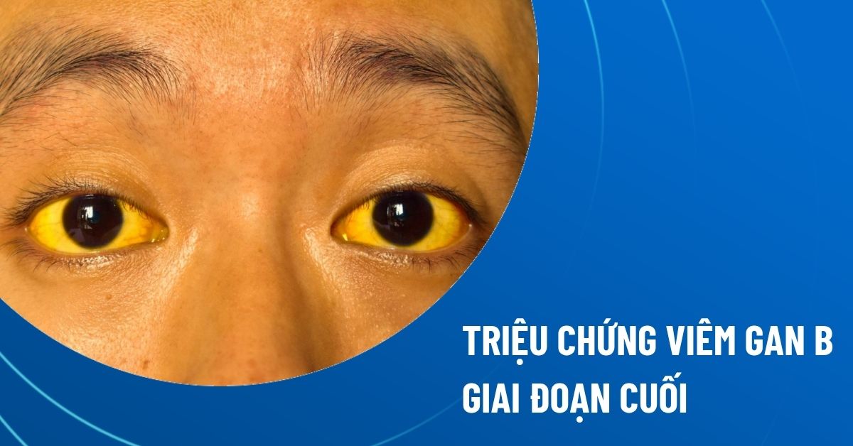 triệu chứng viêm gan b giai đoạn cuối