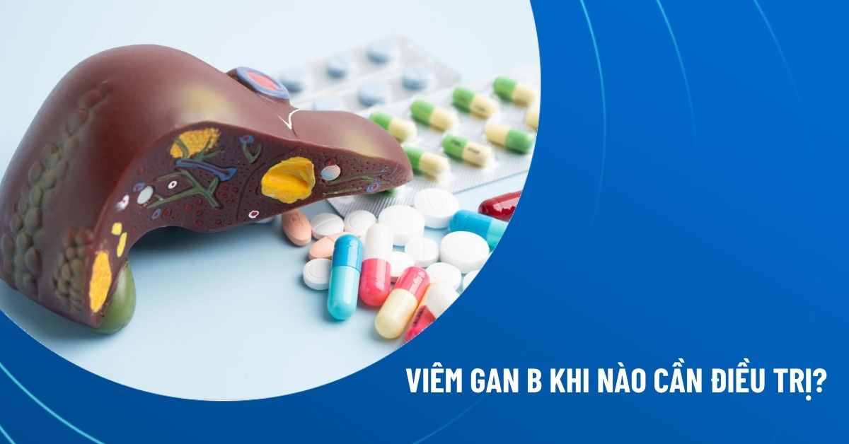 viêm gan b khi nào cần điều trị