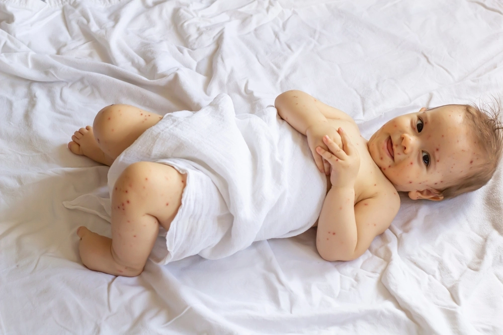 bé nhỏ bị thủy đậu