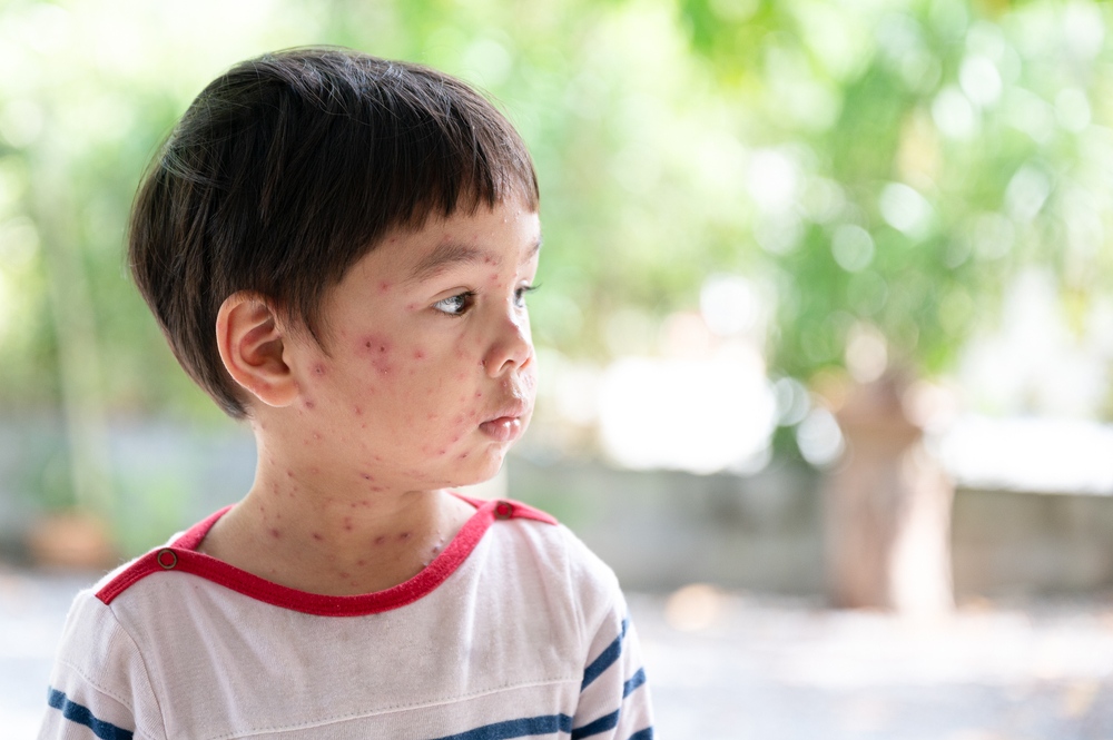 bé trai nổi thủy đậu