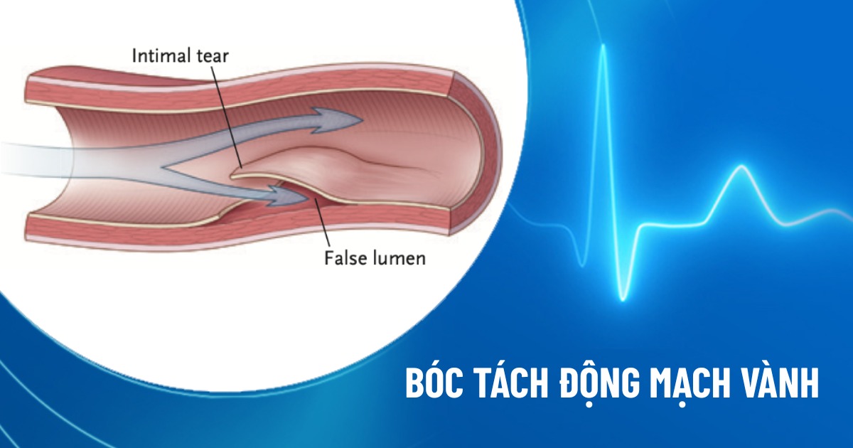 bóc tách động mạch vành tự phát