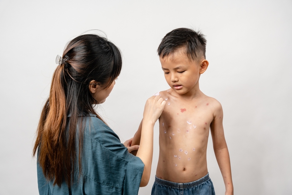 bôi thuốc thủy đậu cho bé trai