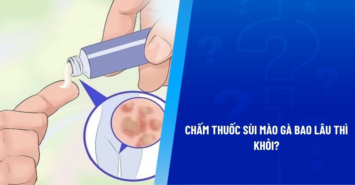 chấm thuốc sùi mào gà bao lâu thì khỏi