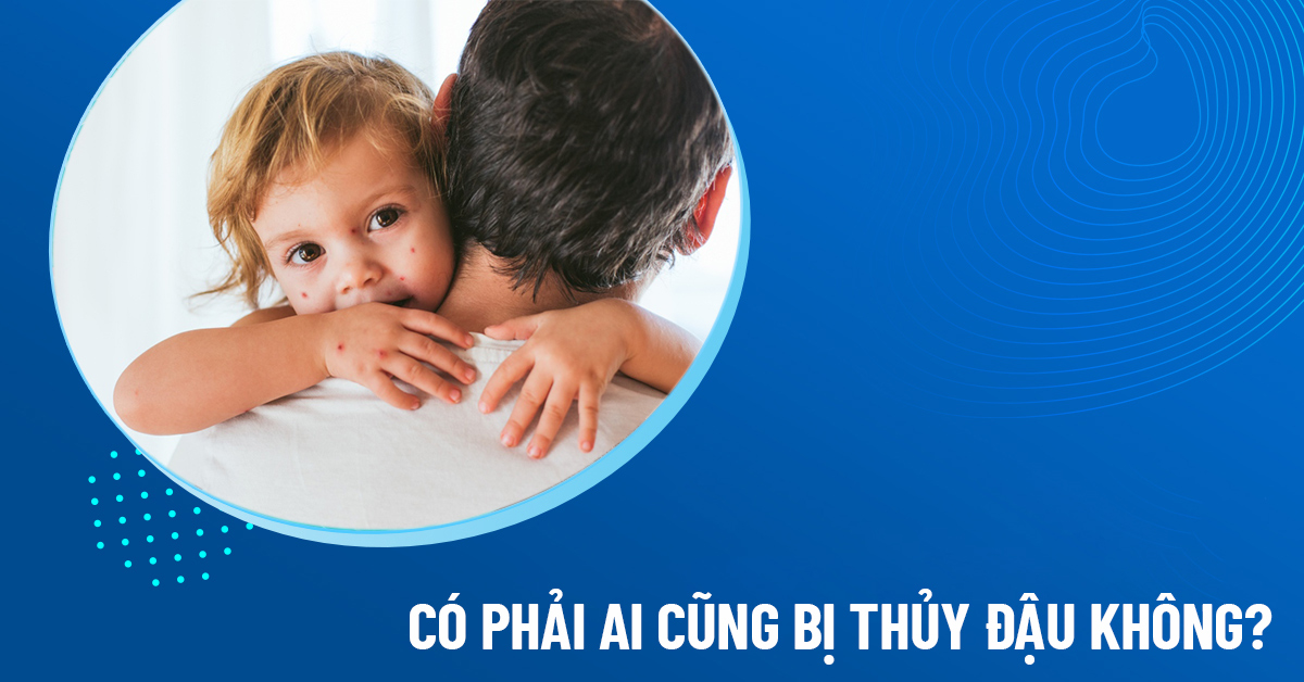 có phải ai cũng bị thủy đậu