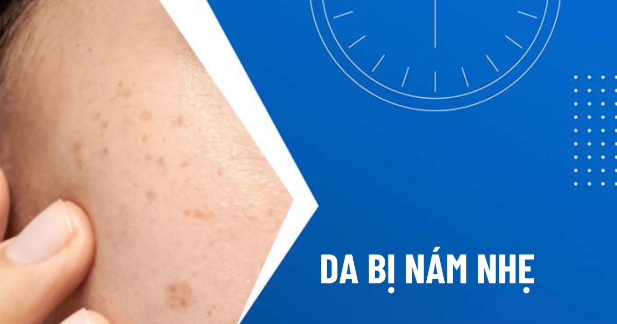 da bị nám nhẹ