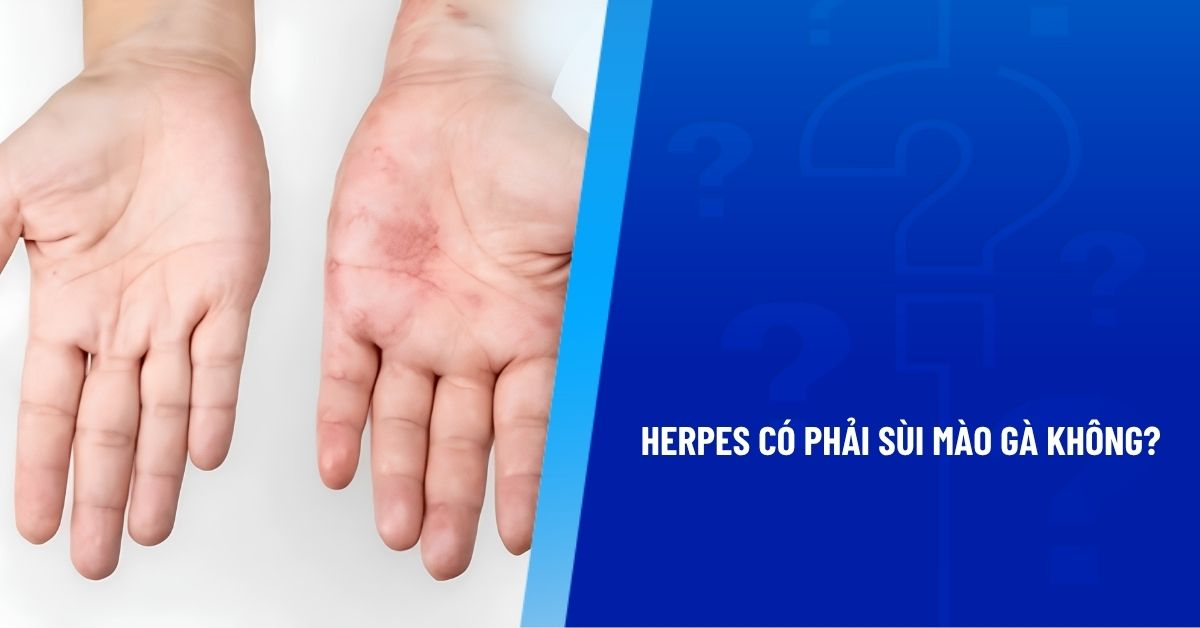 herpes có phải sùi mào gà không
