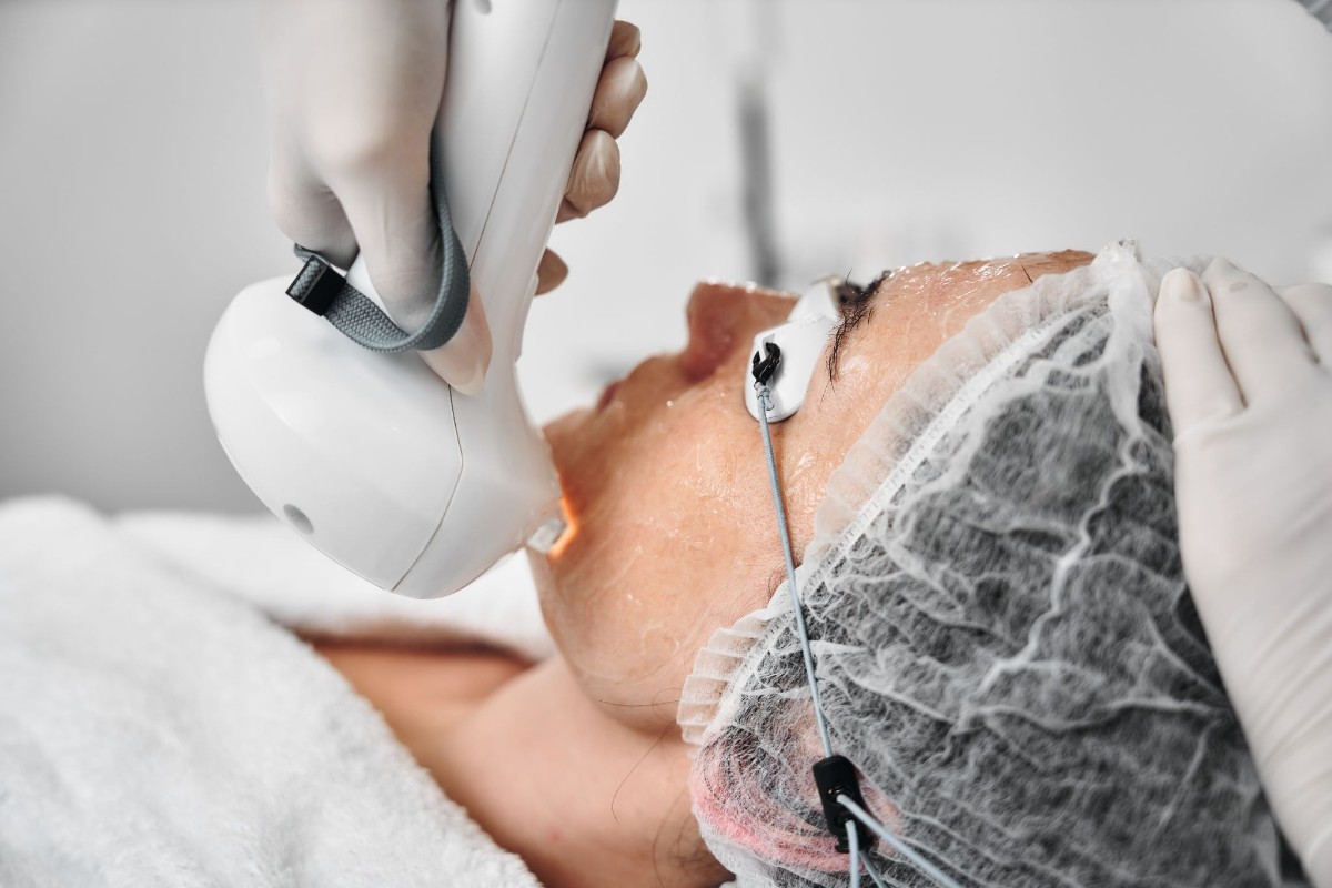 laser trị nám mạch máu