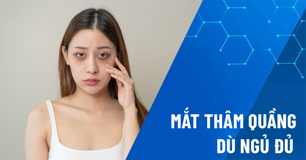 mắt thâm quầng dù ngủ đủ