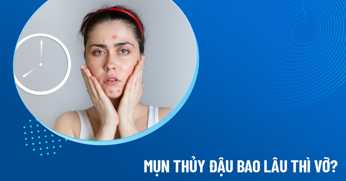 mụn thủy đậu bao lâu thì vỡ