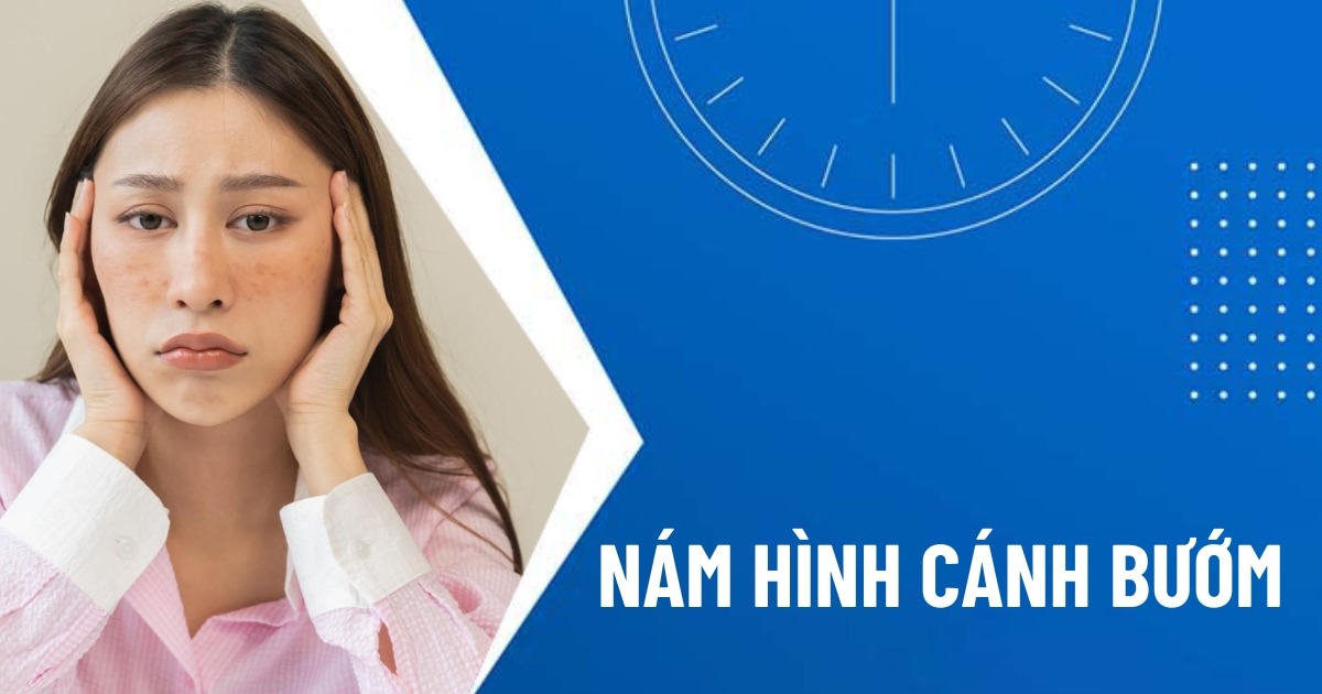 nám cánh bướm