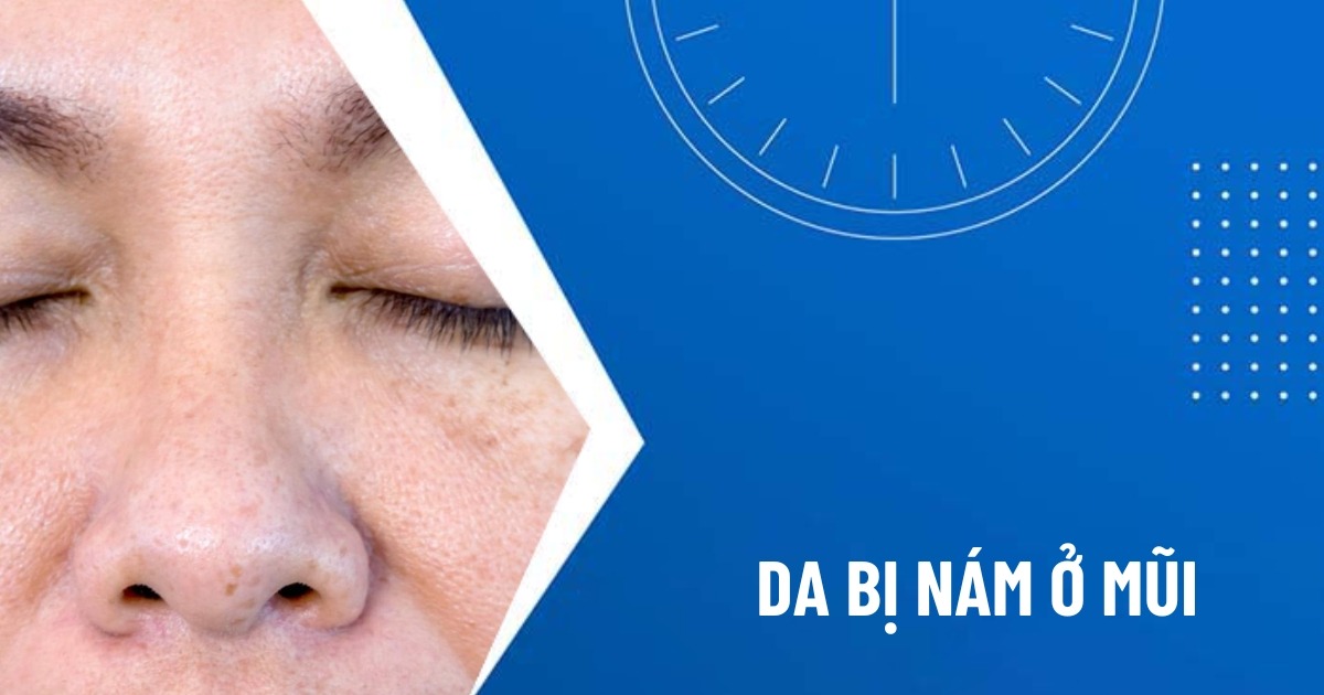 nám ở mũi