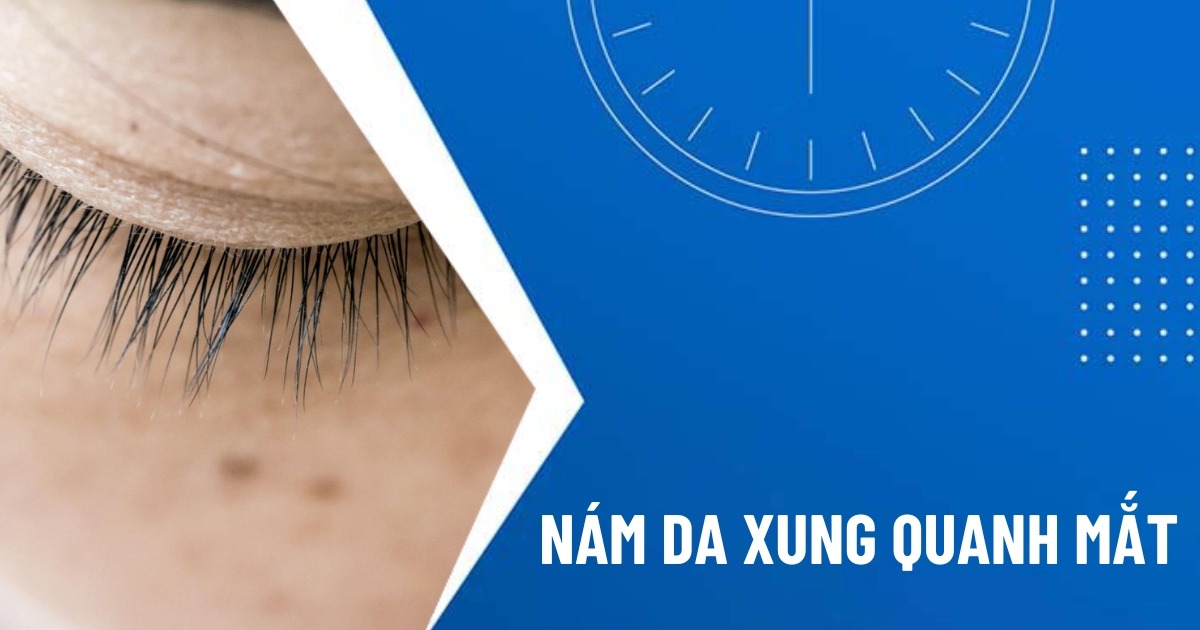 nám quanh mắt