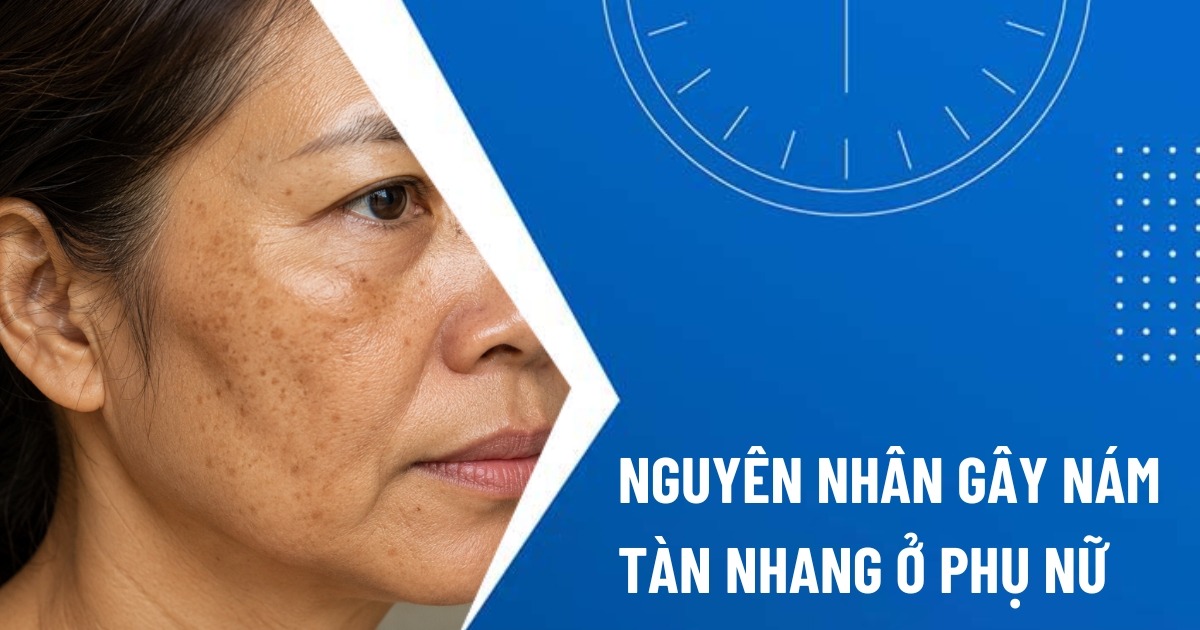nguyên nhân gây nám tàn nhang ở phụ nữ