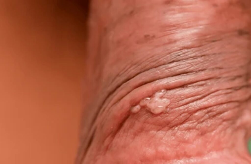 nốt da herpes