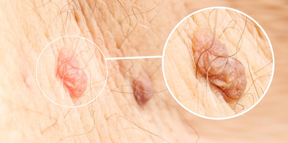 nốt sùi lây qua tiếp xúc da