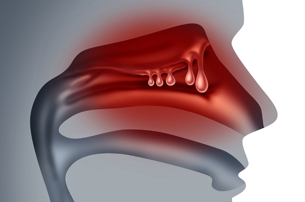 polyp mũi