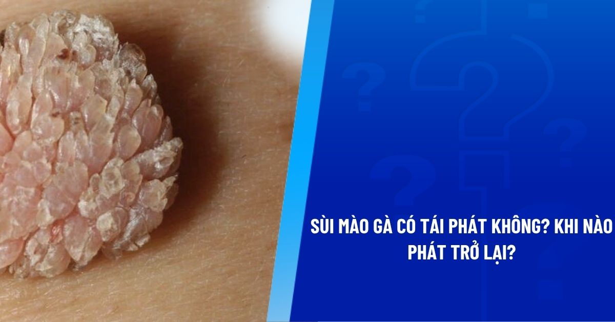 sùi mào gà có tái phát không