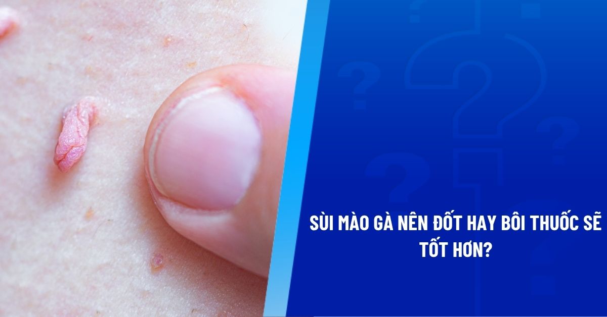 sùi mào gà nên đốt hay bôi thuốc