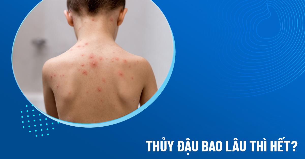 thủy đậu bao lâu thì hết