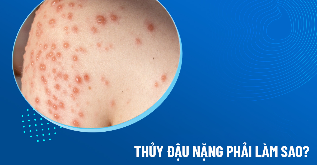 thủy đậu nặng