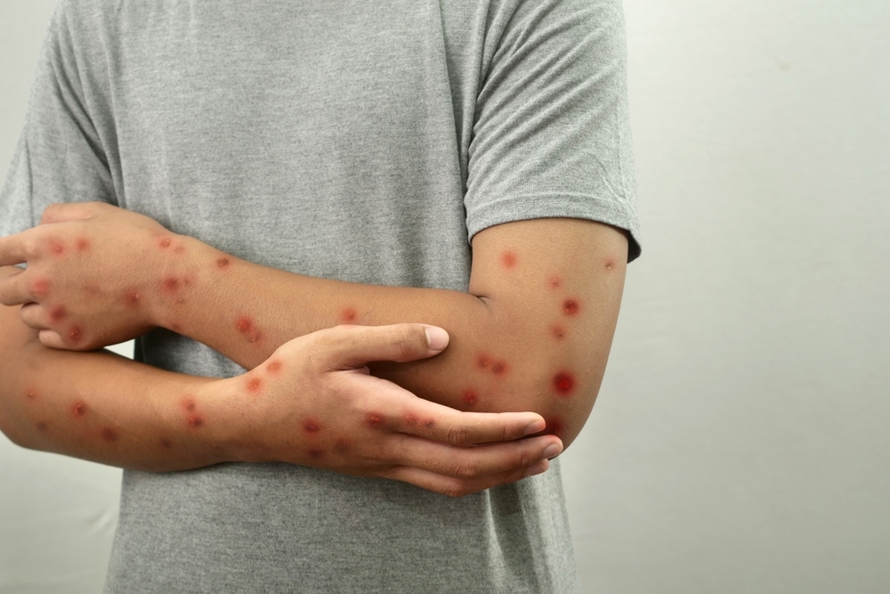 thủy đậu nổi nhiều trên tay