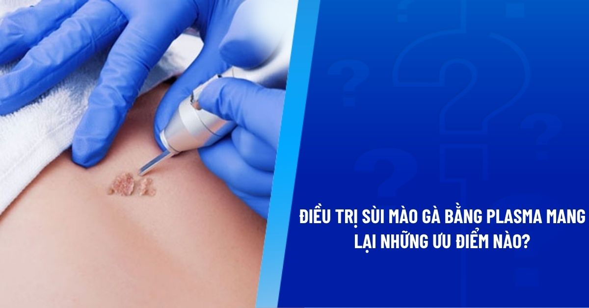 cách điều trị sùi mào gà bằng plasma