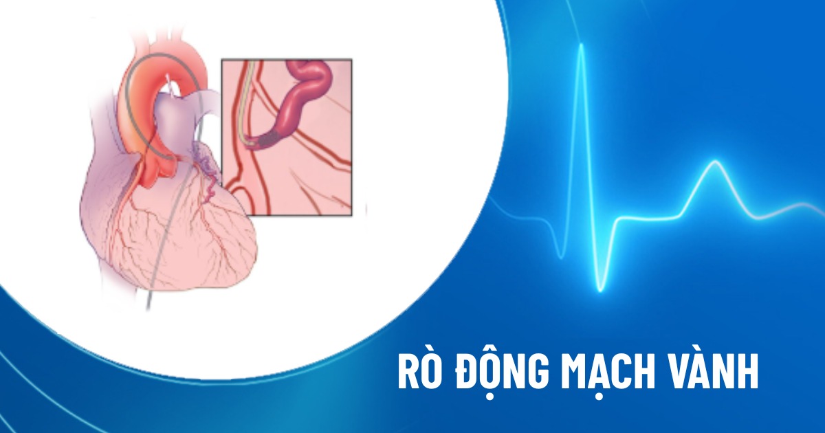 dò động mạch vành