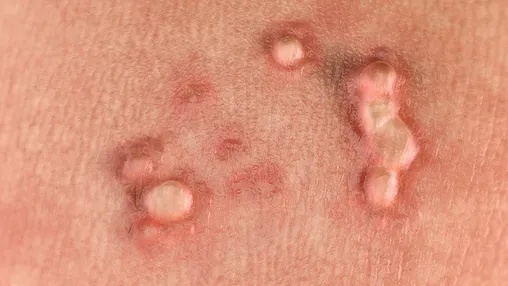 số lượng nốt sùi nhiều