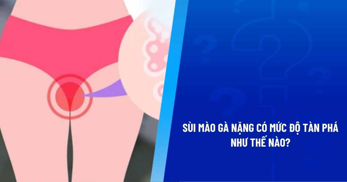sùi mào gà giai đoạn nặng